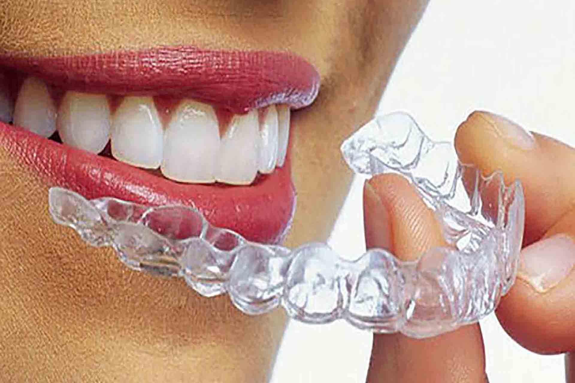 Трейнеры для зубов
