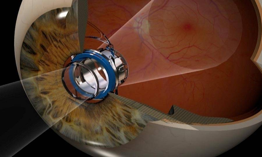 Бионические глаза и нейропротезы: как технологии возвращают зрение слепым